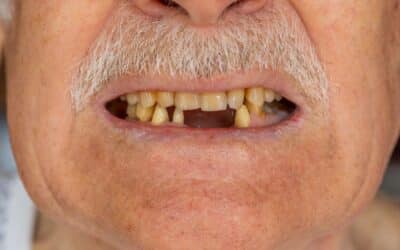 Envejecimiento y pérdida dental: cómo mantener una dentición funcional