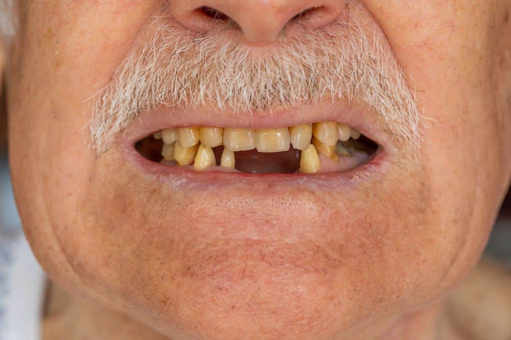 imagen-perdida-dental-edad